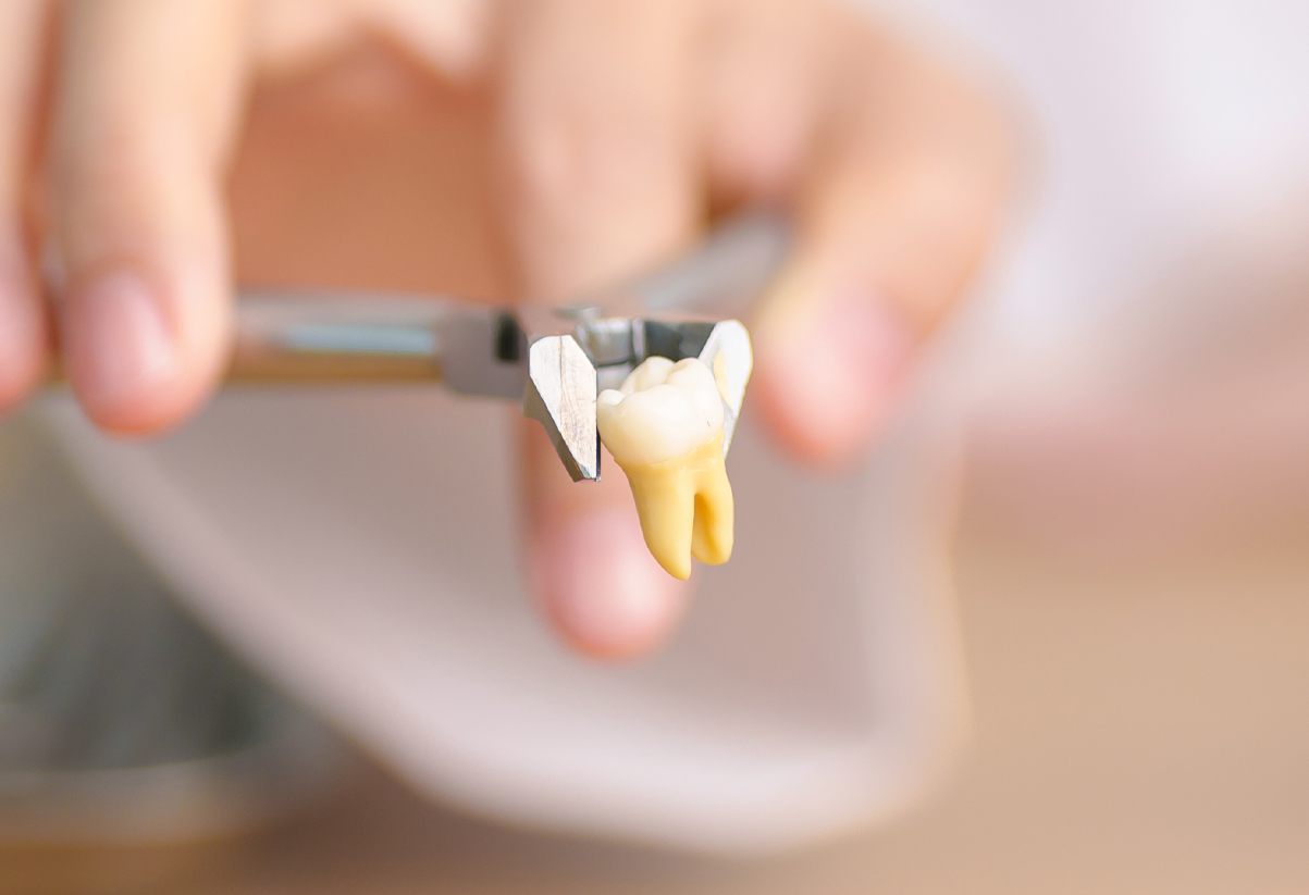 Care after a tooth extraction